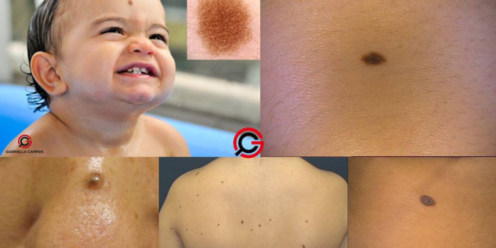 Nevos melanocíticos