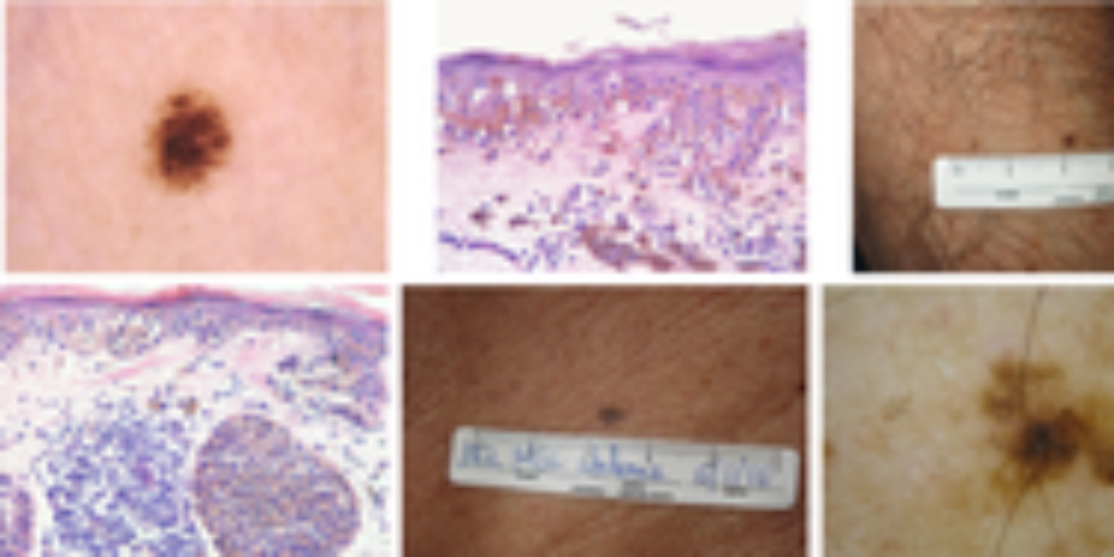 Melanocytic lesions ≤ 6mm