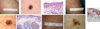 Melanocytic lesions ≤ 6mm